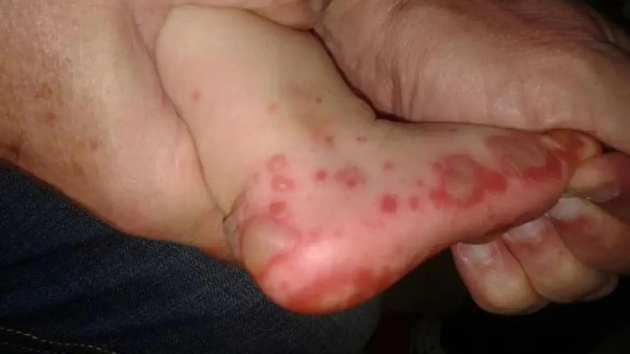 virus boca mano pie